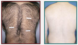 laser hair removal
