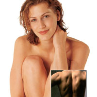 Laser Hair Removal