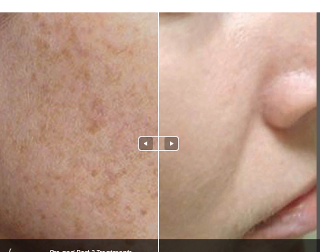 Ipl Photofacial